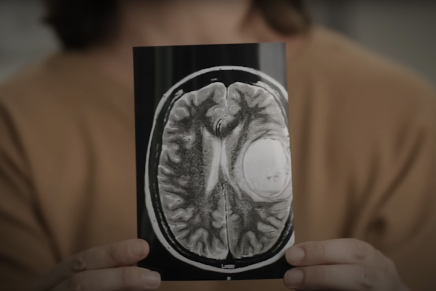 Close-up of Caroline holding an MRI scan of a brain with a visible tumor.