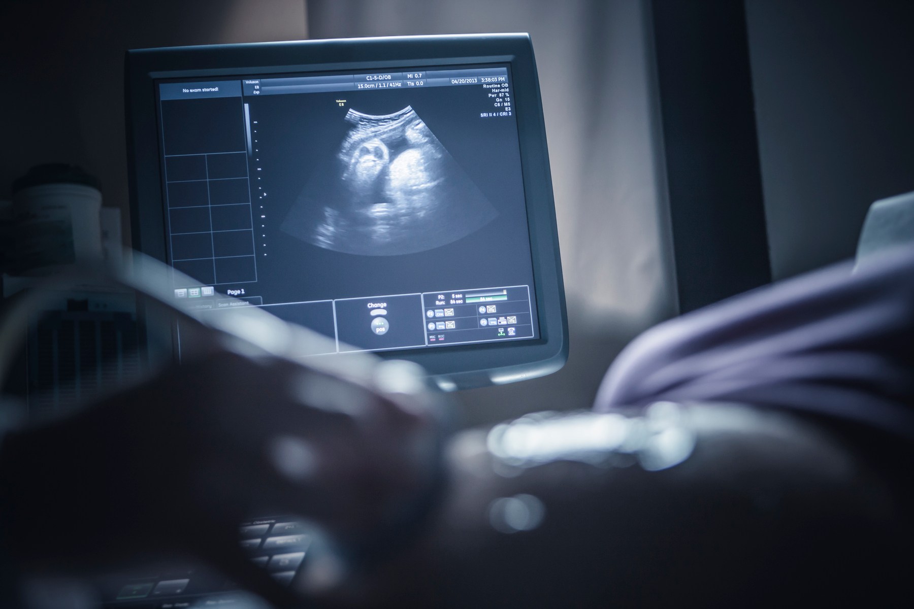 A pregnancy sonogram appears on a screen in a dimly-lit room.